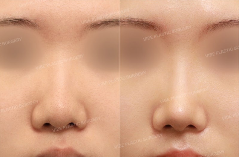 무보형물 코성형 : 나도 가능할까 ?