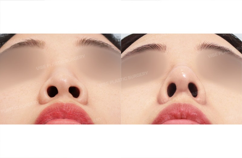 코성형과 이마 지방이식, 함께 고려하는 이유는 무엇일까요? 사진 6